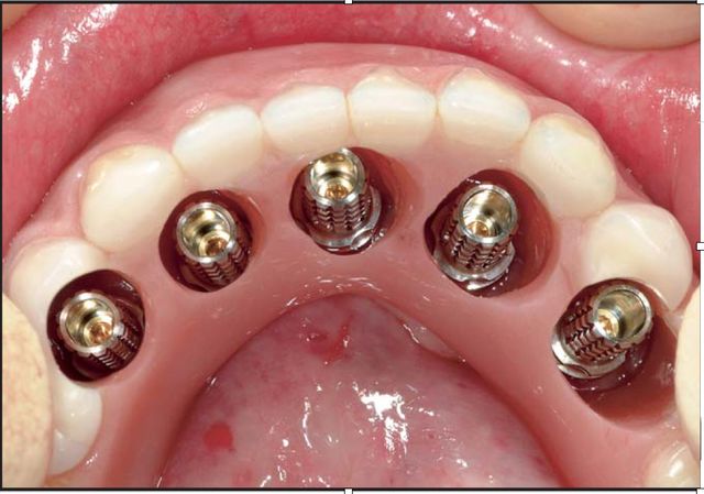 Ampliar imagen: Centro de implantologia oral integral Metepec