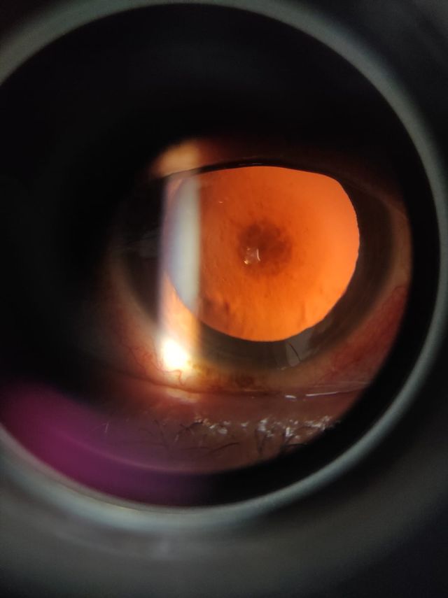 Ampliar imagen: Precision Eye – Dr. Freddy / Crystalline Ópticas