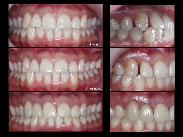 Ampliar imagen: Prótesis e Implantología Oral. Cuernavaca