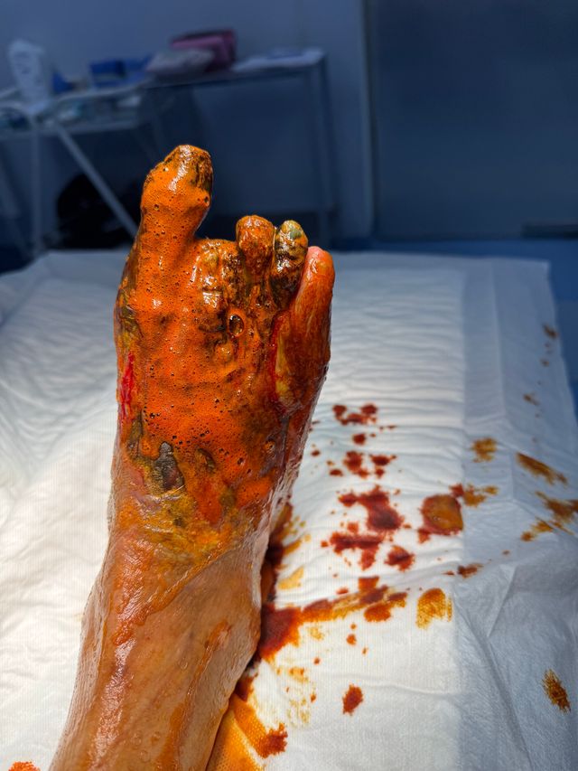 Ampliar imagen: Cirugía y pie diabético San Rafael