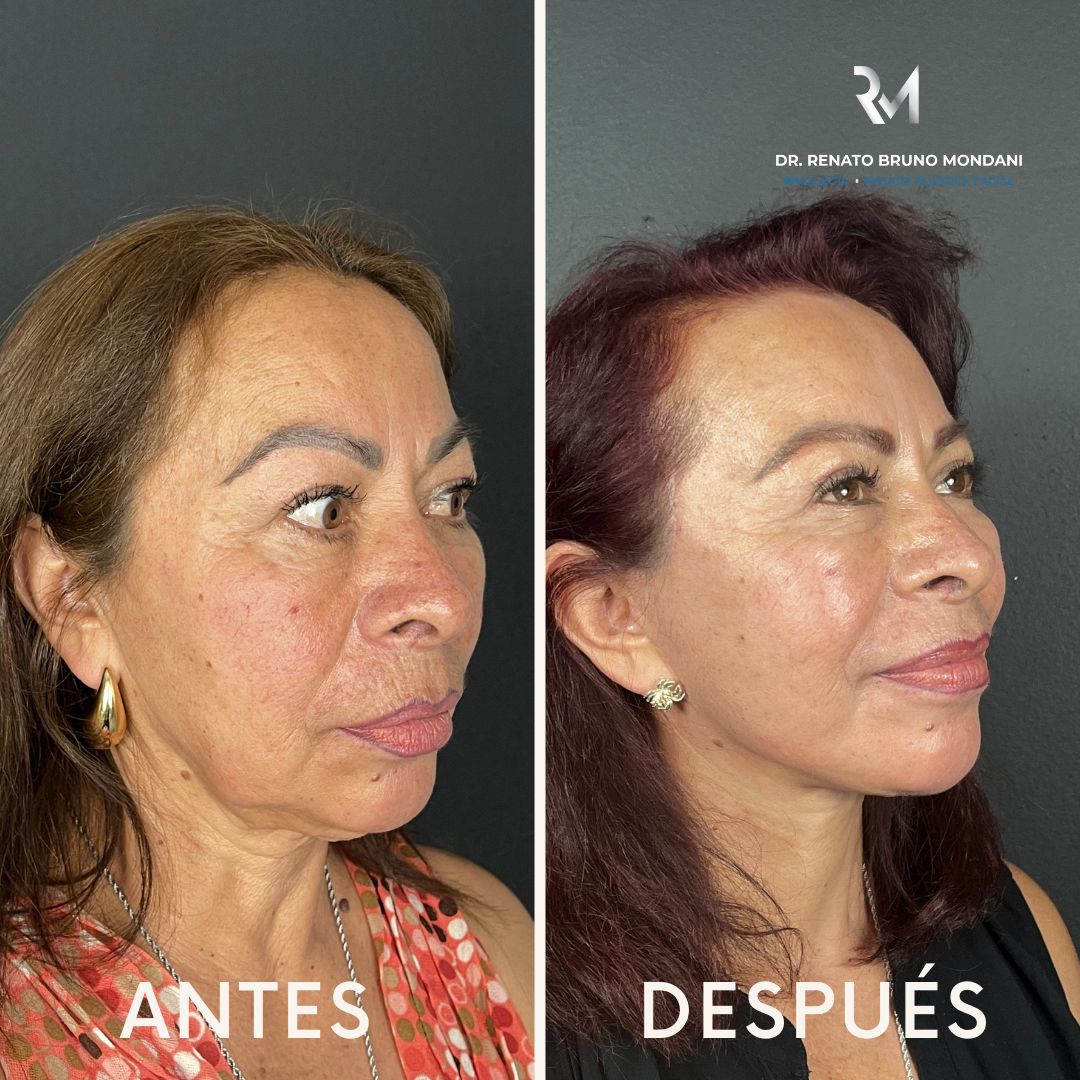 Renato Bruno Mondani-9