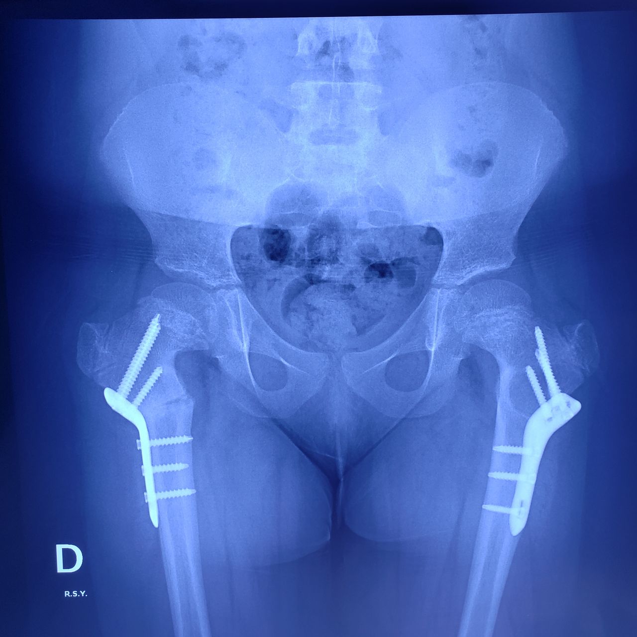 Alfonso Meza Vernis-93