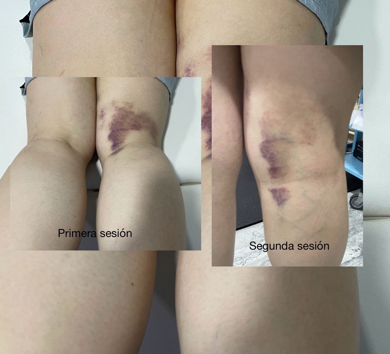 Irving Denilson Peña González-7