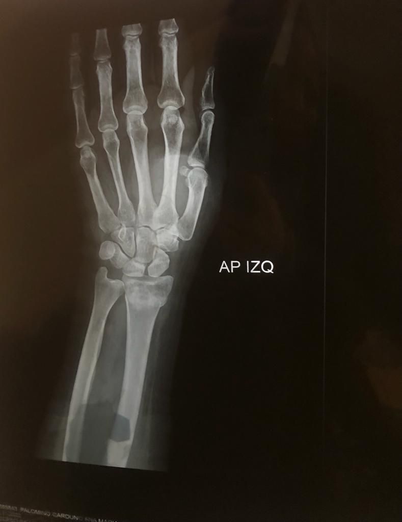 Irving Denilson Peña González-24