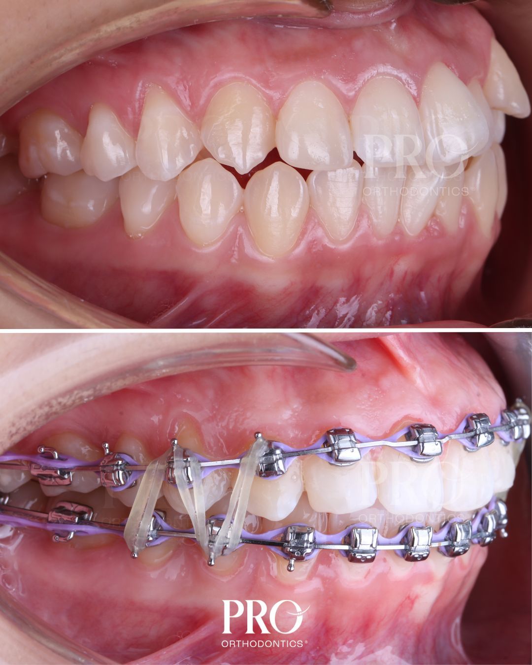 Verail Ruacho-3